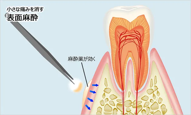 表面麻酔で注射針の「チクっと」する痛みを軽減します！